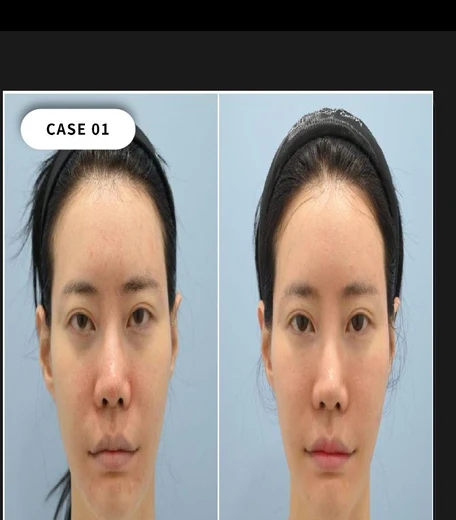 Case 01 — Contour & dark circle improvement