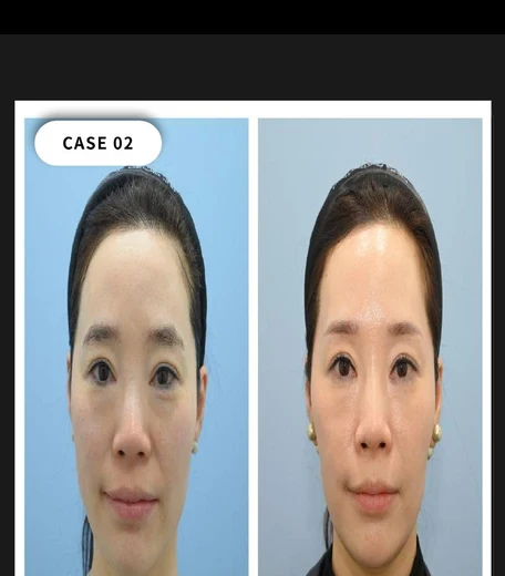Case 02 — Elasticity & rested appearance