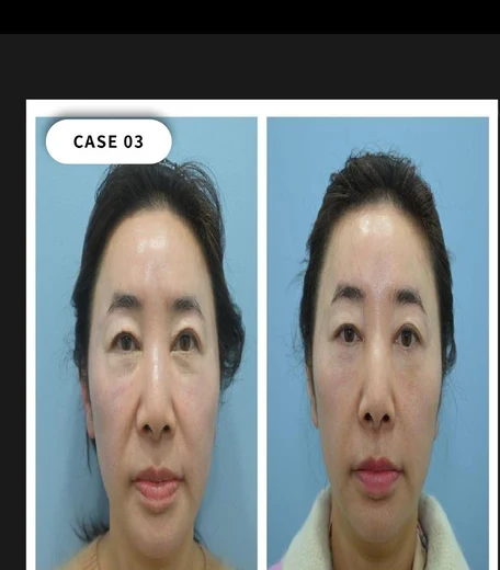 Case 03 — Midface volume restoration