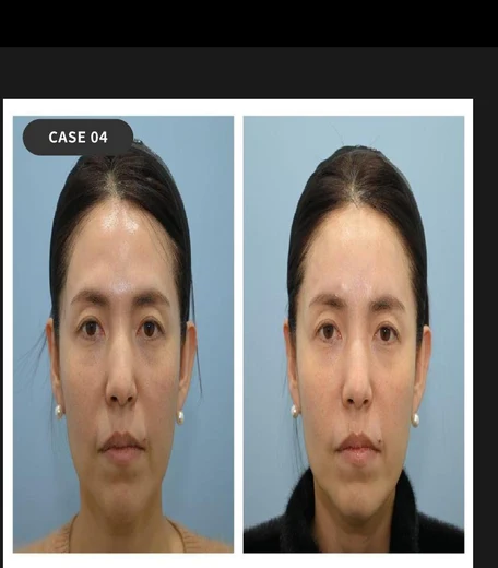 Case 04 — Forehead filler