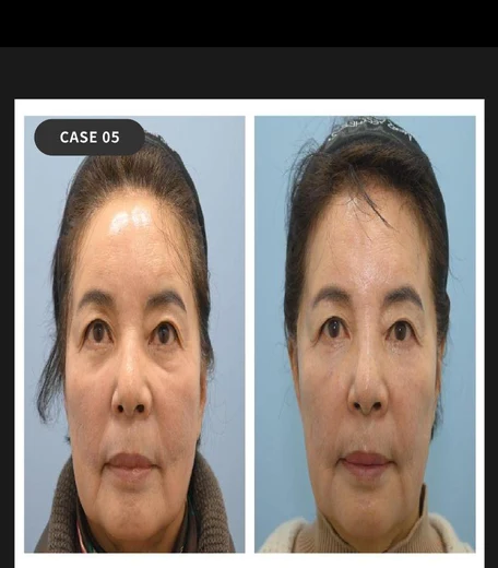 Case 05 — Tear-trough filler + Ulthera