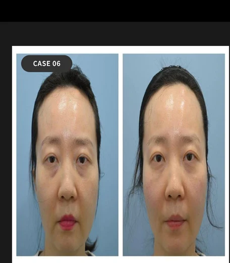 Case 06 — Combined lifting & filler