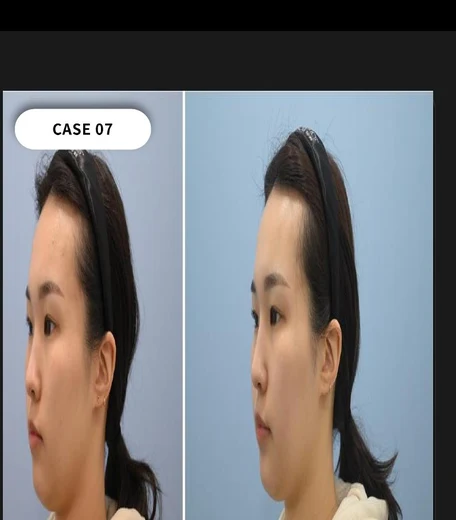 Case 07 — Side face line refinement