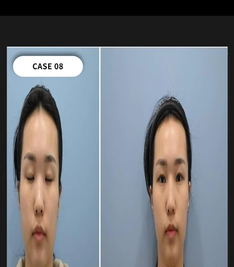 Case 08 — Ulthera + rhinoplasty filler