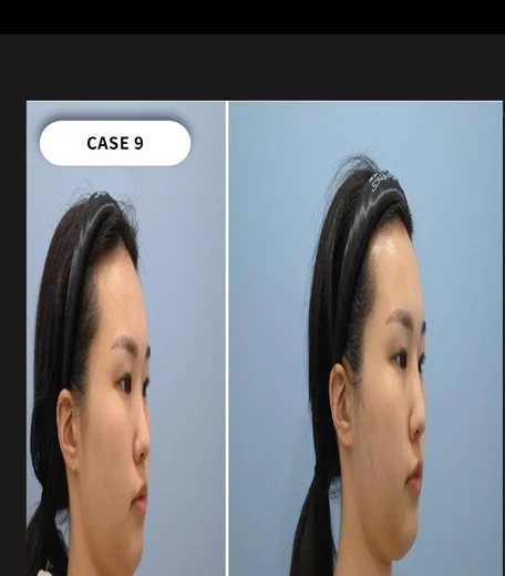 Case 09 — Jawline lifting & contour