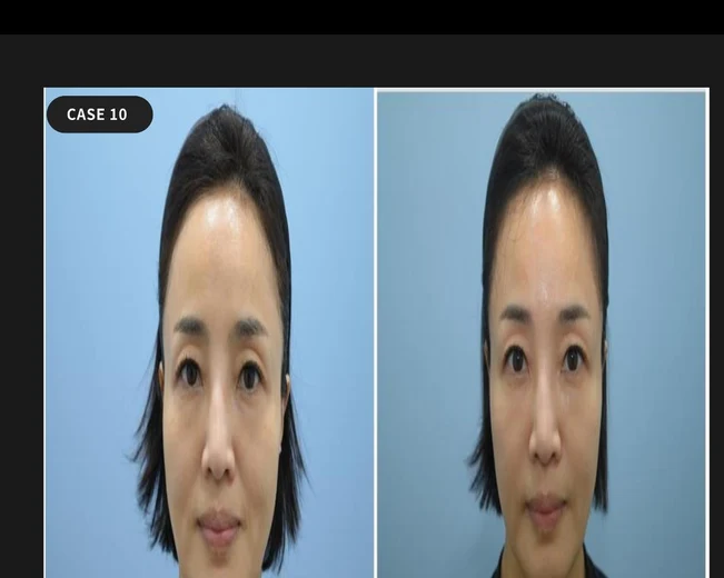 Case 10 — Ulthera + filler follow-up
