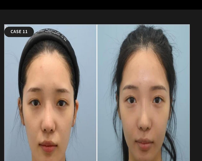 Case 11 — Filler follow-up